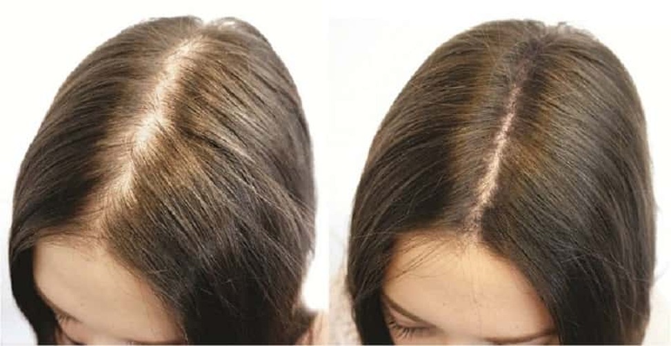 Выпадение волос: причины, методы лечения, полезные советы