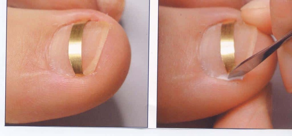 Лечение вросшего ногтя: дома или у хирурга? - АМК
