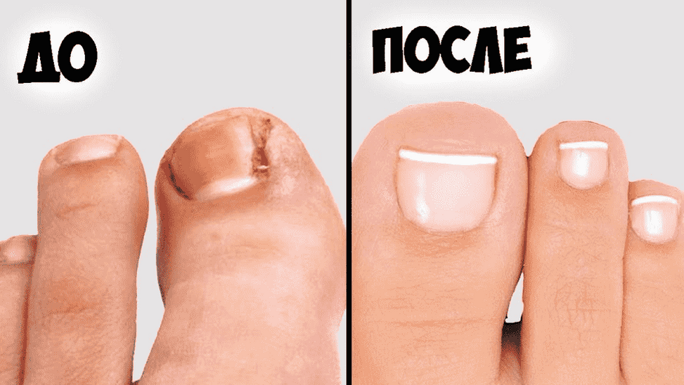Дерматолог объяснила, как избавиться от грибка ногтей – Москва 24, 