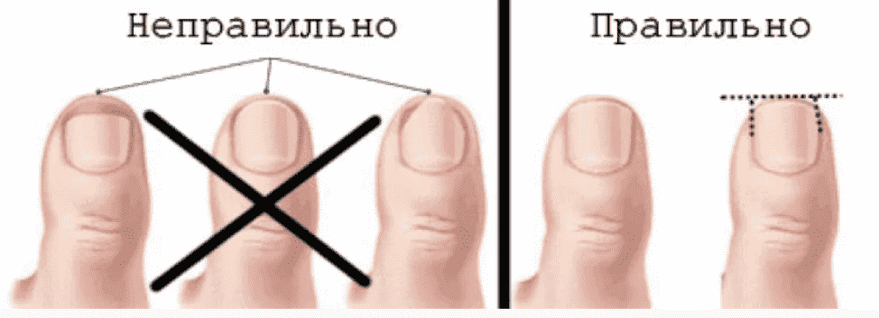 Вросший ноготь - коррекция, удаление и лечение ногтей в Санкт-Петербурге лазером