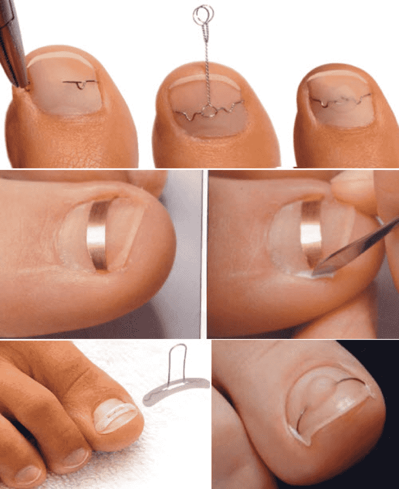 Лечение вросшего ногтя: дома или у хирурга?